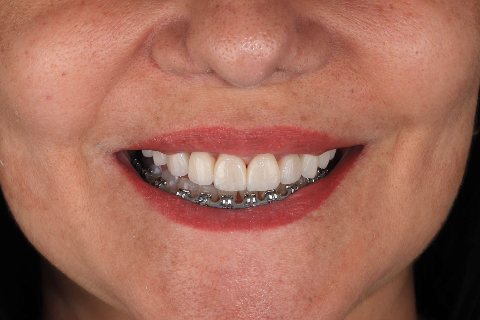 Antes — restauração