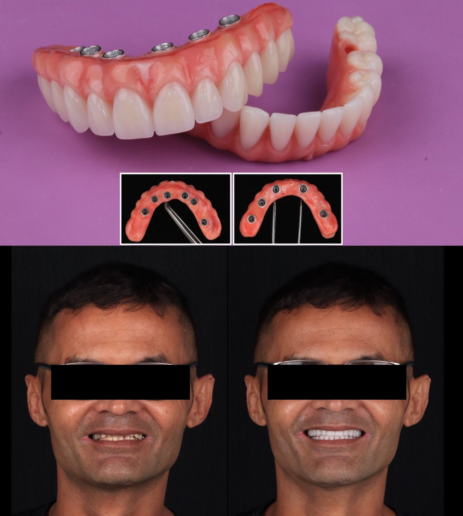Antes e depois — implantes All-on (masculino)