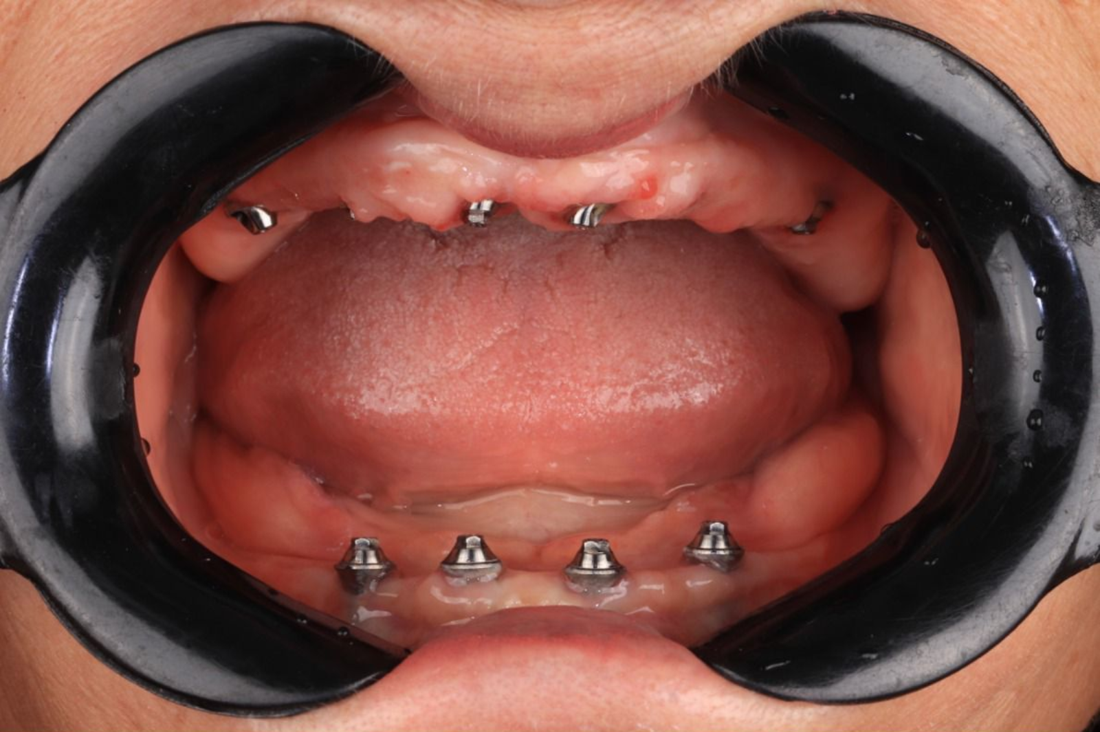 Depois — implantes