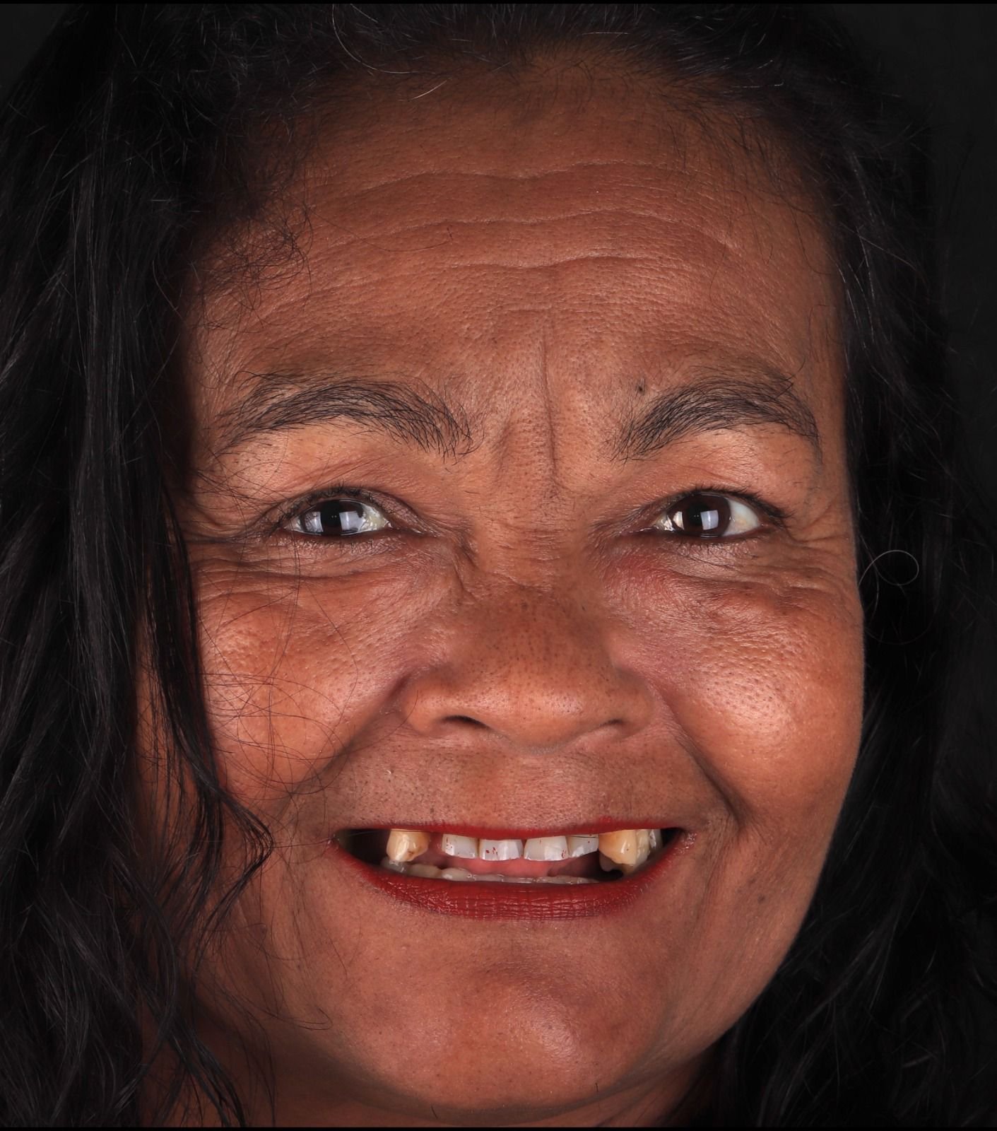 Antes — necessidade de reabilitação