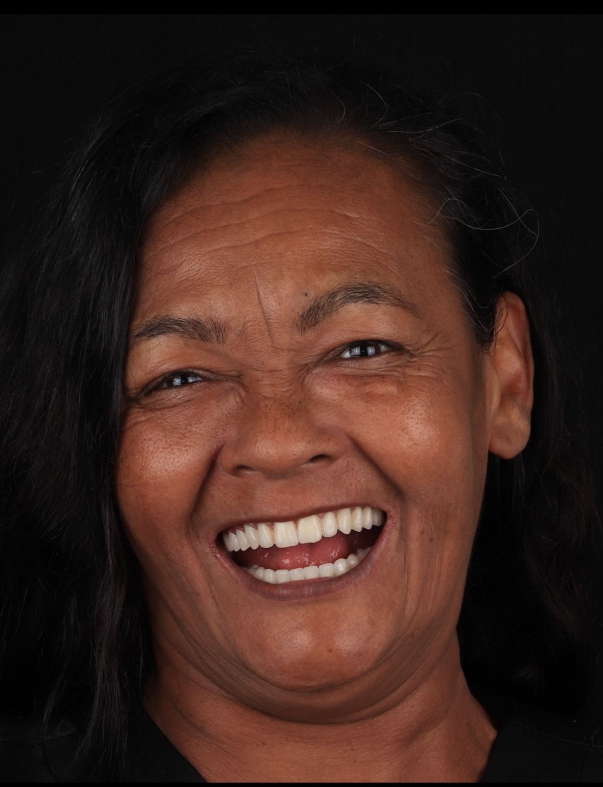 Depois — resultado final com implantes